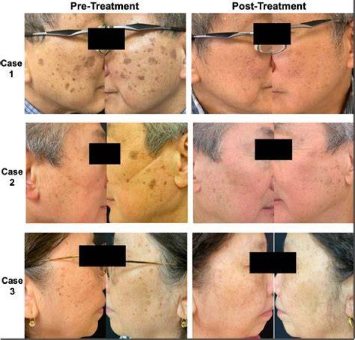 Seborrheic Keratosis Treatment Ideas In Seborrheic Keratosis